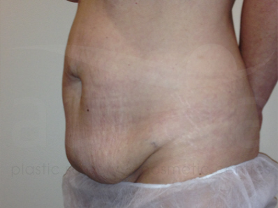 Before-Tummy Tuck