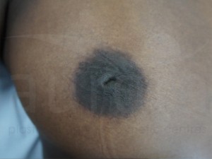 Inverted nipple before and after photos Aurora Clinics 6