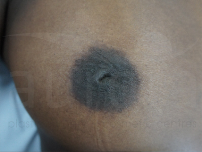 Before-Inverted nipple