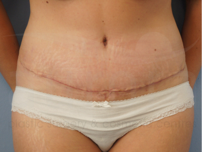 After-Tummy Tuck