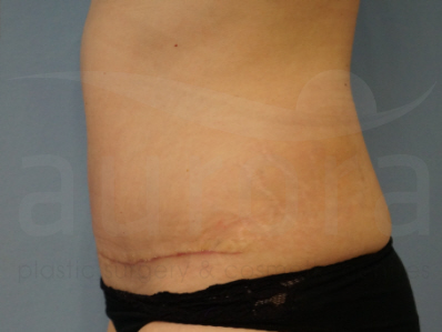 After-Tummy Tuck