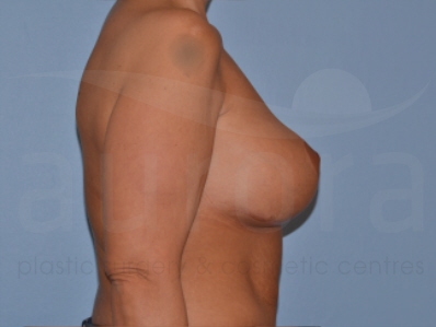 Before-Removal and replacement of implants