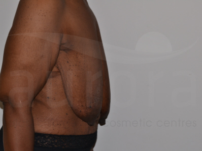 Before-Breast uplift