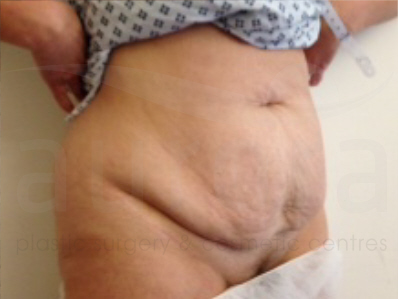 Before-Tummy Tuck