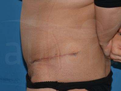 After-Tummy Tuck