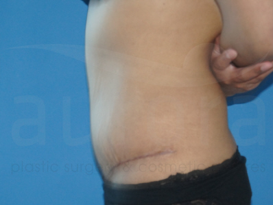 After-Tummy Tuck