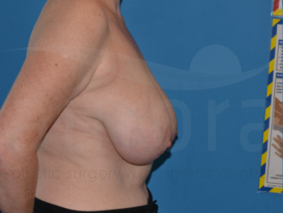 Before-Breast Reduction