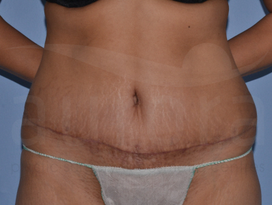 After-Tummy Tuck