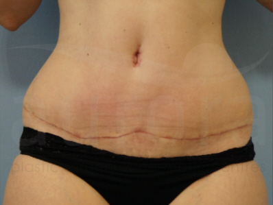 After-Tummy Tuck