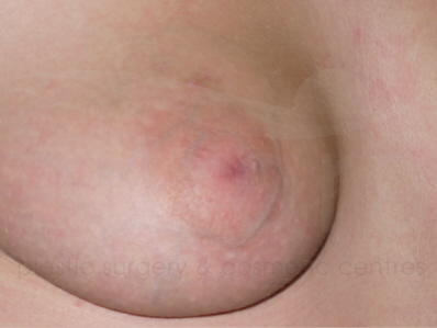 Before-Inverted Nipple