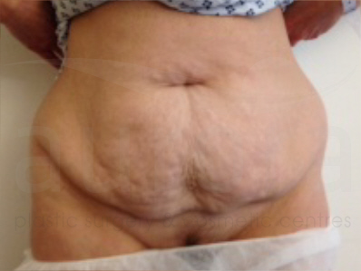 Before-Tummy Tuck