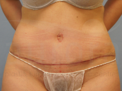 After-Tummy Tuck