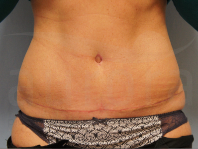 After-Tummy Tuck