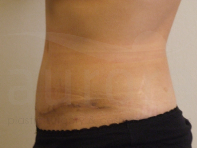 After-Tummy Tuck