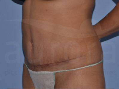 After-Tummy Tuck