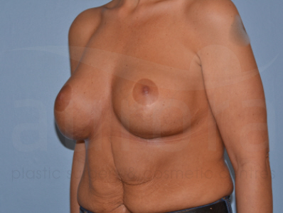 Before-Removal and replacement of implants