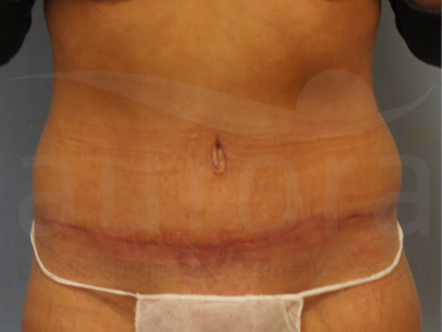 After-TummyTuck