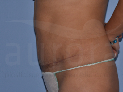 After-Tummy Tuck