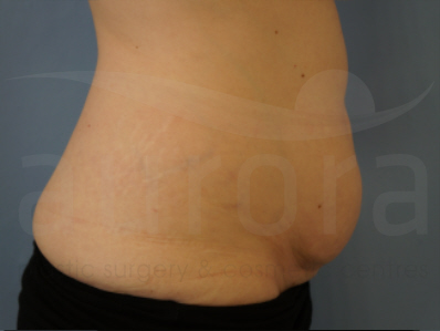 Before-Tummy Tuck