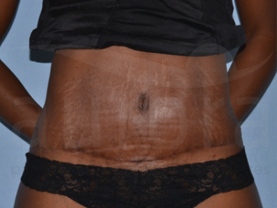 After-Tummy Tuck