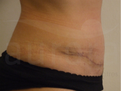 After-Tummy Tuck