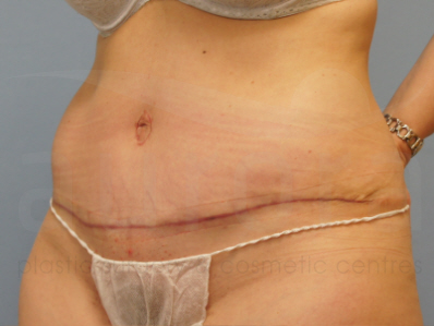 After-Tummy Tuck