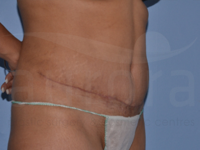 After-Tummy Tuck