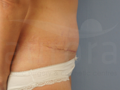 After-Tummy Tuck