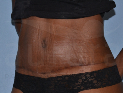 After-Tummy Tuck