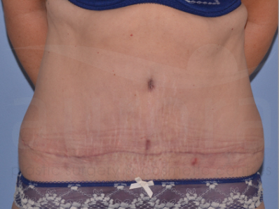 After-Tummy Tuck