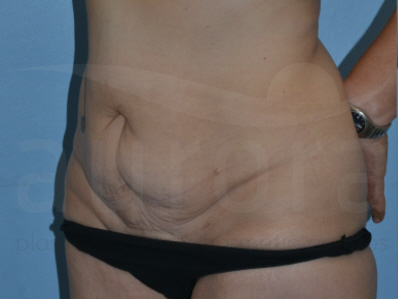 Before-Tummy Tuck