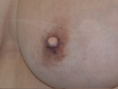 After-Inverted nipple