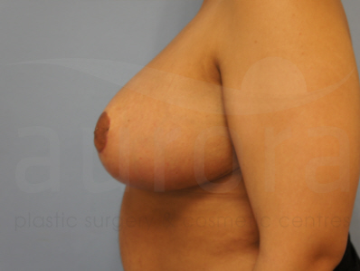 After-Breast Reduction