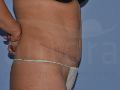 After-Tummy Tuck