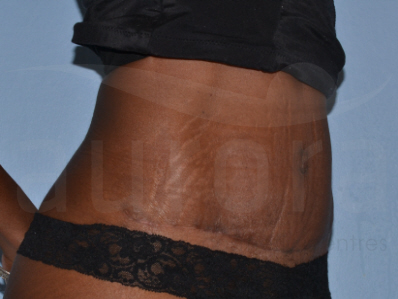 After-Tummy Tuck