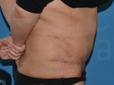 After-Tummy Tuck