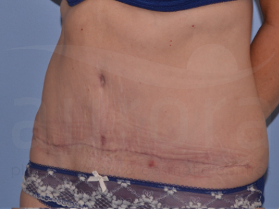 After-Tummy Tuck