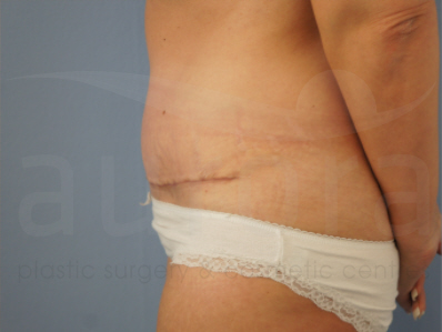 After-Tummy Tuck