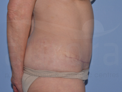 After-Tummy Tuck