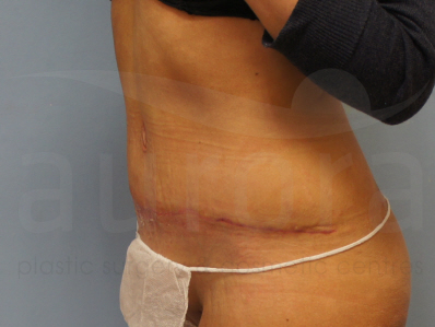 After-Tummy Tuck