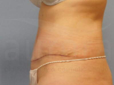 After-Tummy Tuck