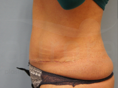 After-Tummy Tuck