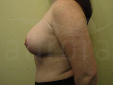 After-Breast Enlargement with Uplift