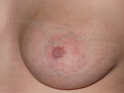 After-Inverted Nipple