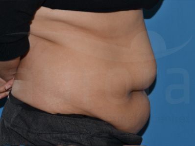 Before-Tummy Tuck