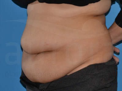 Before-Tummy Tuck