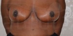 Breast uplift before and after photos Aurora Clinics 16