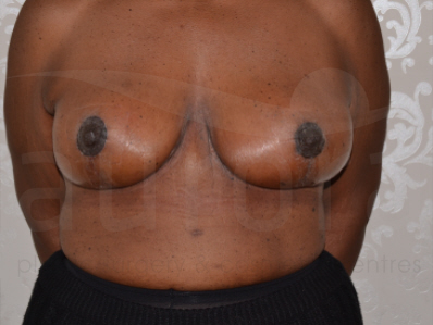 After-Breast uplift