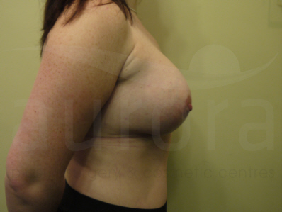 After-Breast Enlargement with Uplift