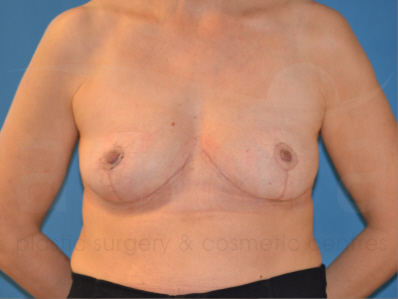 After-Breast Implant Removal